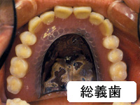 金属床フルデンチャー